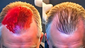 PRP – osocze bogatopłytkowe w leczeniu włosów